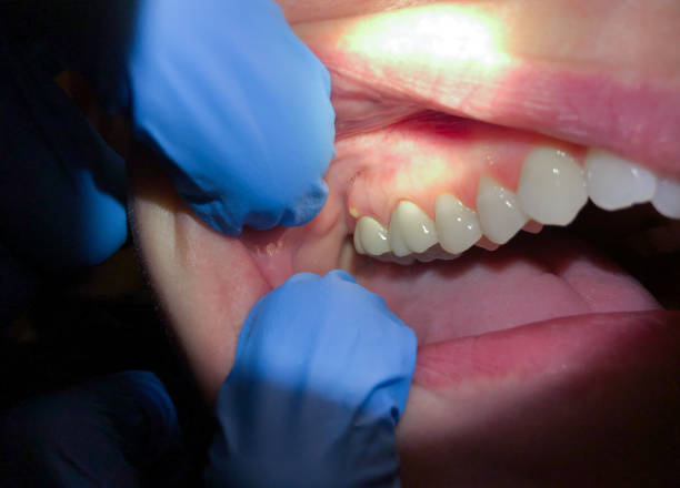 Best Emergency Treatment for Dental Infections or Abscesses in Delta, CO